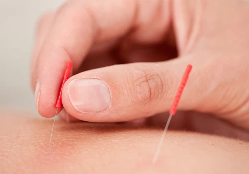 Chiropractic St Louis Park MN Benefits of Acupuncture