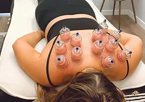 Chiropractor St Louis Park MN Cupping Patient